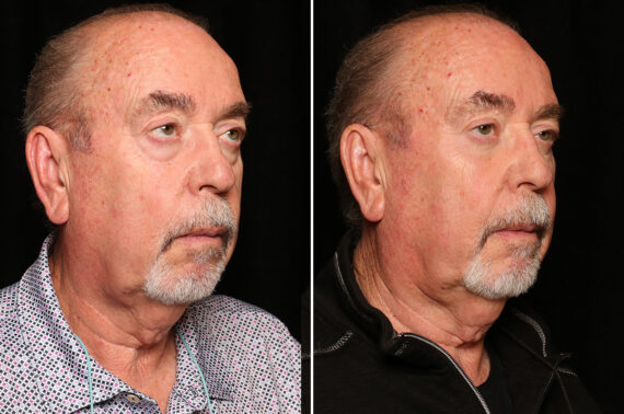 LuxeLift Before and After Photos in Cincinnati, OH, Patient 18809