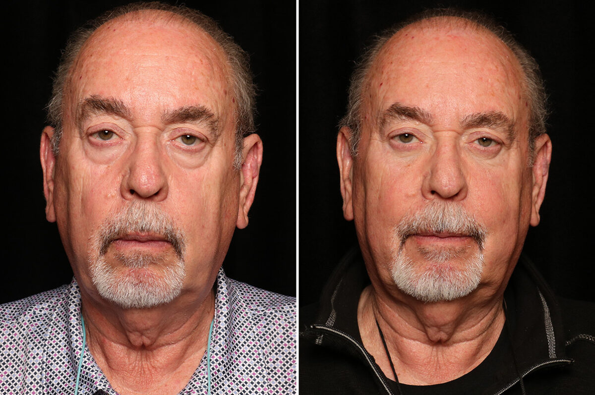 LuxeLift Before and After Photos in Cincinnati, OH, Patient 18809