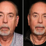 LuxeLift Before and After Photos in Cincinnati, OH, Patient 18809