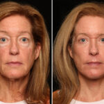 Blepharoplasty Before and After Photos in Cincinnati, OH, Patient 19114