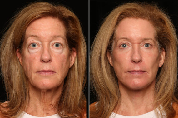 Blepharoplasty Before and After Photos in Cincinnati, OH, Patient 19114
