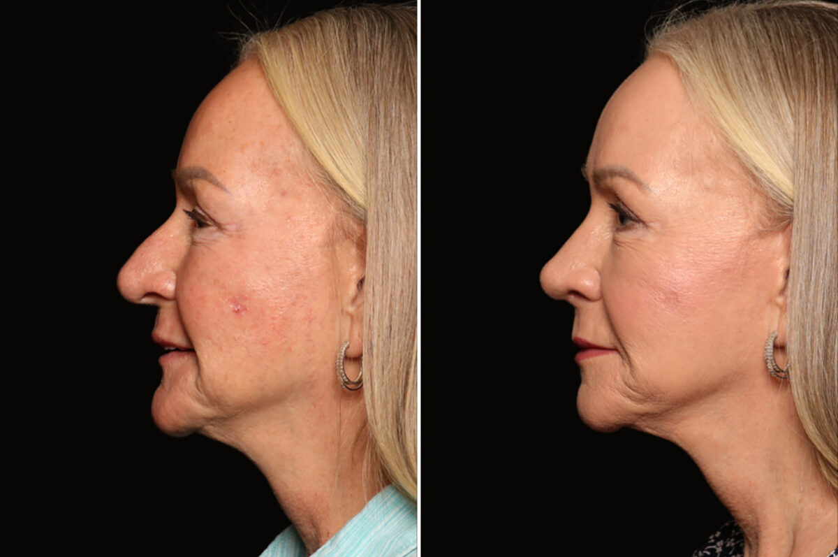 Rhinoplasty (Nose Reshaping) Before and After Photos in Cincinnati, OH, Patient 19128