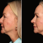 Rhinoplasty (Nose Reshaping) Before and After Photos in Cincinnati, OH, Patient 19128