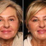 Blepharoplasty Before and After Photos in Cincinnati, OH, Patient 19130