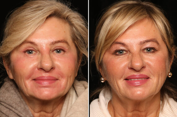 Blepharoplasty Before and After Photos in Cincinnati, OH, Patient 19130