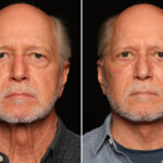 Blepharoplasty Before and After Photos in Cincinnati, OH, Patient 19132