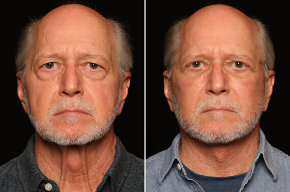 Blepharoplasty Before and After Photos in Cincinnati, OH, Patient 19132