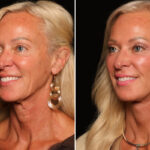 Fractional c02 Laser Before and After Photos in Cincinnati, OH, Patient 19134