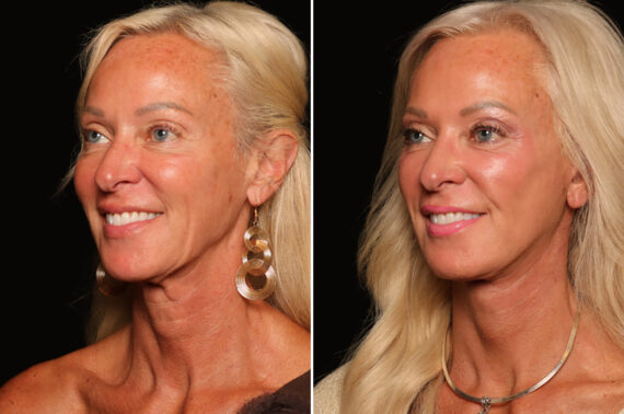 Fractional c02 Laser Before and After Photos in Cincinnati, OH