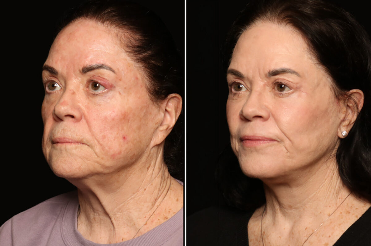 Blepharoplasty Before and After Photos in Cincinnati, OH, Patient 19136