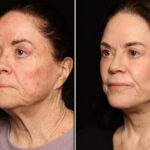 Blepharoplasty Before and After Photos in Cincinnati, OH, Patient 19136