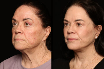 Fractional c02 Laser Before and After Photos in Cincinnati, OH, Patient 19136