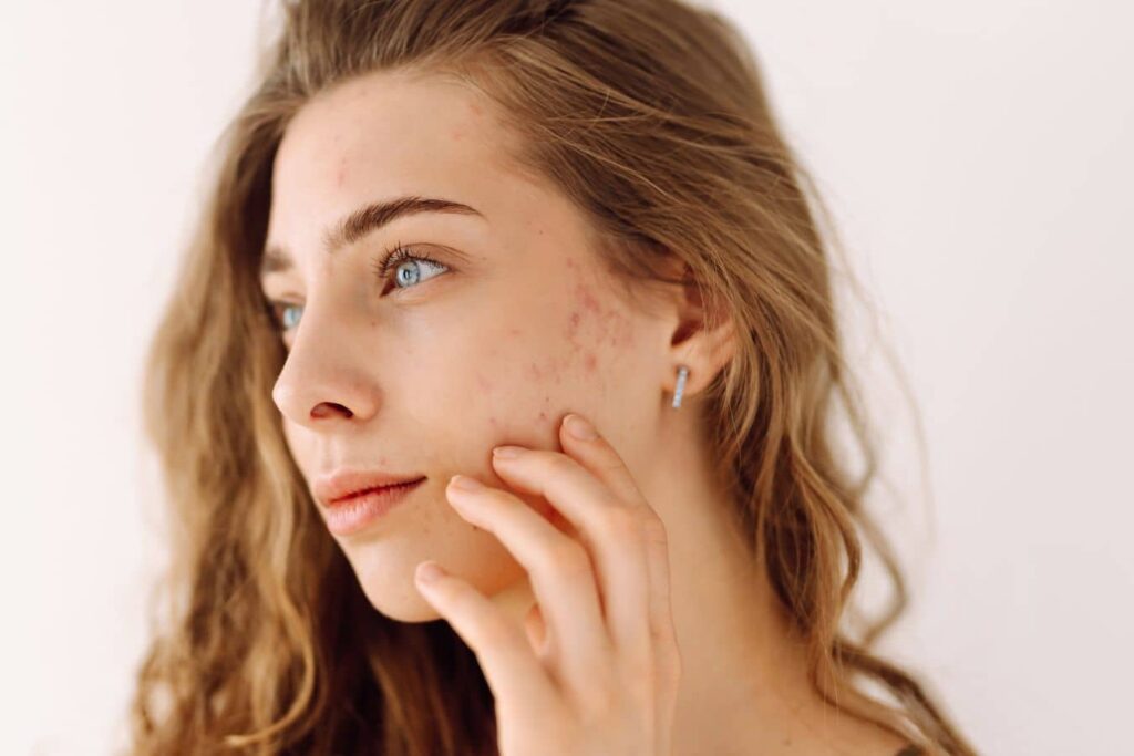 Woman touching cheek with acne marks, highlighting microdermabrasion results for mild scars and discoloration