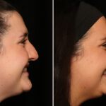 Rhinoplasty (Nose Reshaping) Before and After Photos in Cincinnati, OH, Patient 19597