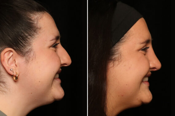 Rhinoplasty (Nose Reshaping) Before and After Photos in Cincinnati, OH, Patient 19597