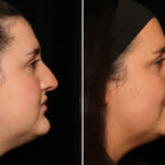 Rhinoplasty (Nose Reshaping) Before and After Photos in Cincinnati, OH, Patient 19597