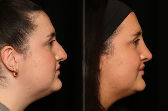 Rhinoplasty (Nose Reshaping) Before and After Photos in Cincinnati, OH, Patient 19597