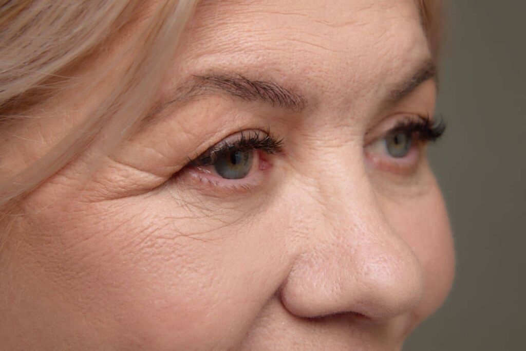 Close-up of mature eyes showing eyelid wrinkles and blepharoplasty concerns around the eye area