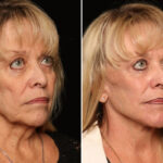 Fractional c02 Laser Before and After Photos in Cincinnati, OH, Patient 19766
