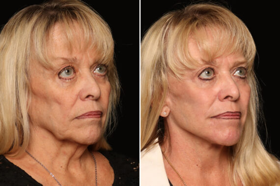 Fractional c02 Laser Before and After Photos in Cincinnati, OH, Patient 19766