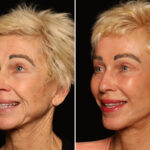 Blepharoplasty Before and After Photos in Cincinnati, OH, Patient 19782
