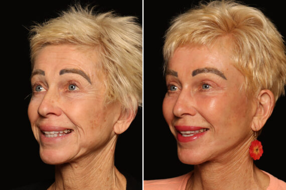 Blepharoplasty Before and After Photos in Cincinnati, OH, Patient 19782