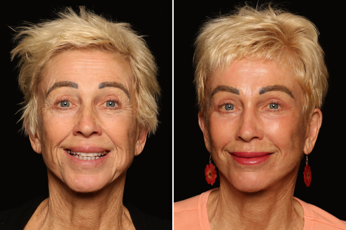 Blepharoplasty Before and After Photos in Cincinnati, OH, Patient 19782
