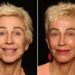 Blepharoplasty Before and After Photos in Cincinnati, OH, Patient 19782