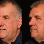 Reconstructive / Other Before and After Photos in Cincinnati, OH, Patient 19785
