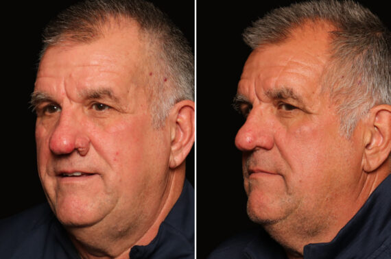 Reconstructive / Other Before and After Photos in Cincinnati, OH, Patient 19785