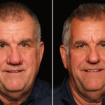 Reconstructive / Other Before and After Photos in Cincinnati, OH, Patient 19785