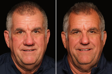 Reconstructive / Other Before and After Photos in Cincinnati, OH, Patient 19785