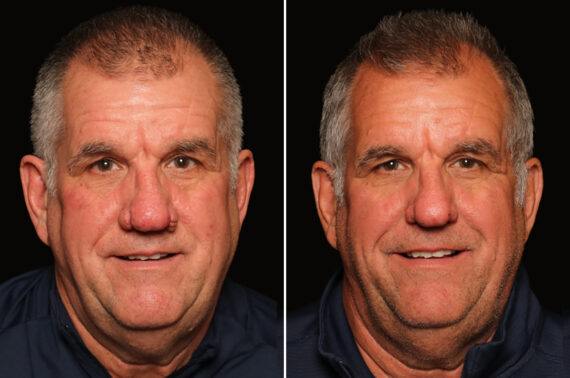 Reconstructive / Other Before and After Photos in Cincinnati, OH, Patient 19785