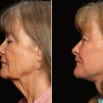 Fractional c02 Laser Before and After Photos in Cincinnati, OH, Patient 19788