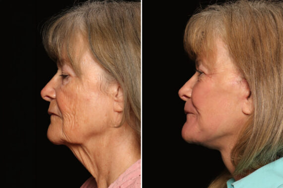 Fractional c02 Laser Before and After Photos in Cincinnati, OH, Patient 19788