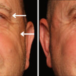 Blepharoplasty Before and After Photos in Cincinnati, OH, Patient 19790