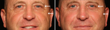 Blepharoplasty Before and After Photos in Cincinnati, OH, Patient 19790