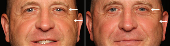 Blepharoplasty Before and After Photos in Cincinnati, OH, Patient 19790
