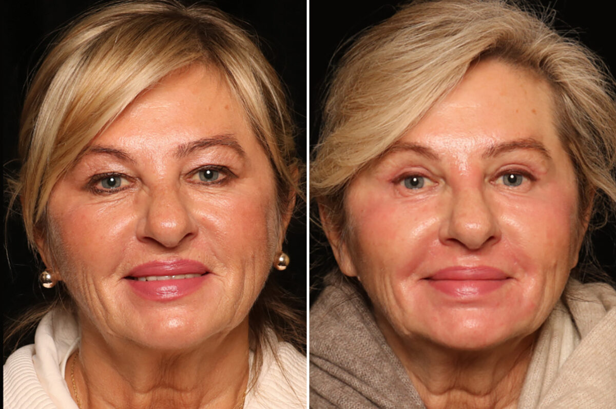 Blepharoplasty Before and After Photos in Cincinnati, OH, Patient 19130