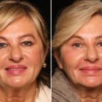 Blepharoplasty Before and After Photos in Cincinnati, OH, Patient 19130