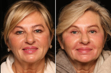 Blepharoplasty Before and After Photos in Cincinnati, OH, Patient 19130