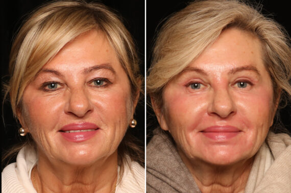 Blepharoplasty Before and After Photos in Cincinnati, OH, Patient 19130