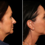 Fractional c02 Laser Before and After Photos in Cincinnati, OH, Patient 19858