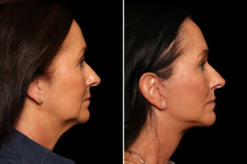 Fractional c02 Laser Before and After Photos in Cincinnati, OH, Patient 19858