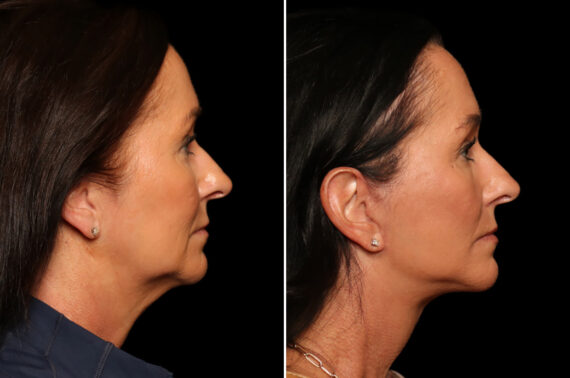 Fractional c02 Laser Before and After Photos in Cincinnati, OH, Patient 19858