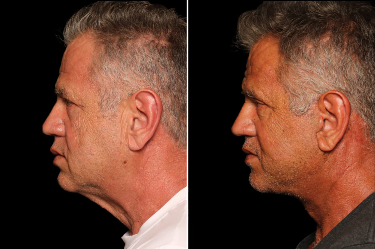 Blepharoplasty Before and After Photos in Cincinnati, OH, Patient 19864