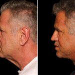 Blepharoplasty Before and After Photos in Cincinnati, OH, Patient 19864