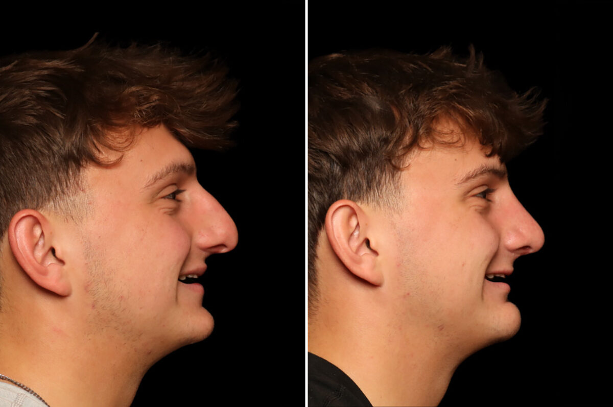 Rhinoplasty (Nose Reshaping) Before and After Photos in Cincinnati, OH, Patient 19911