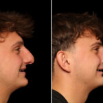 Rhinoplasty (Nose Reshaping) Before and After Photos in Cincinnati, OH, Patient 19911