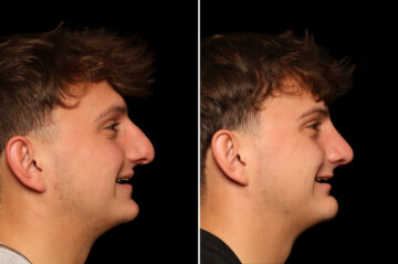 Rhinoplasty (Nose Reshaping) Before and After Photos in Cincinnati, OH, Patient 19911